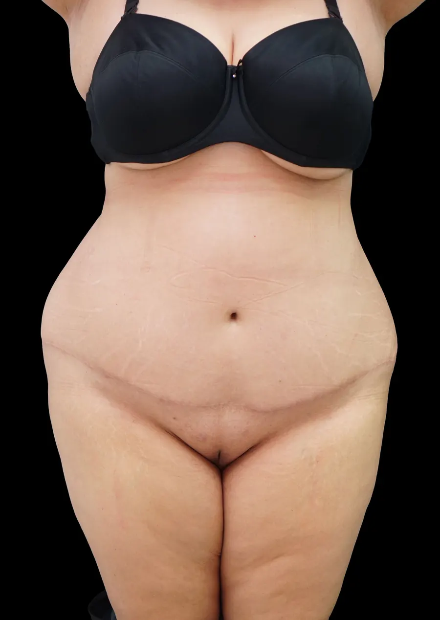 Abdominoplastia: resultado tras la intervención