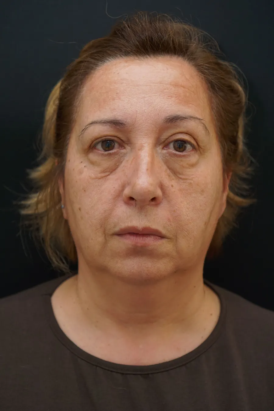 Blefaroplastia: antes de la intervención