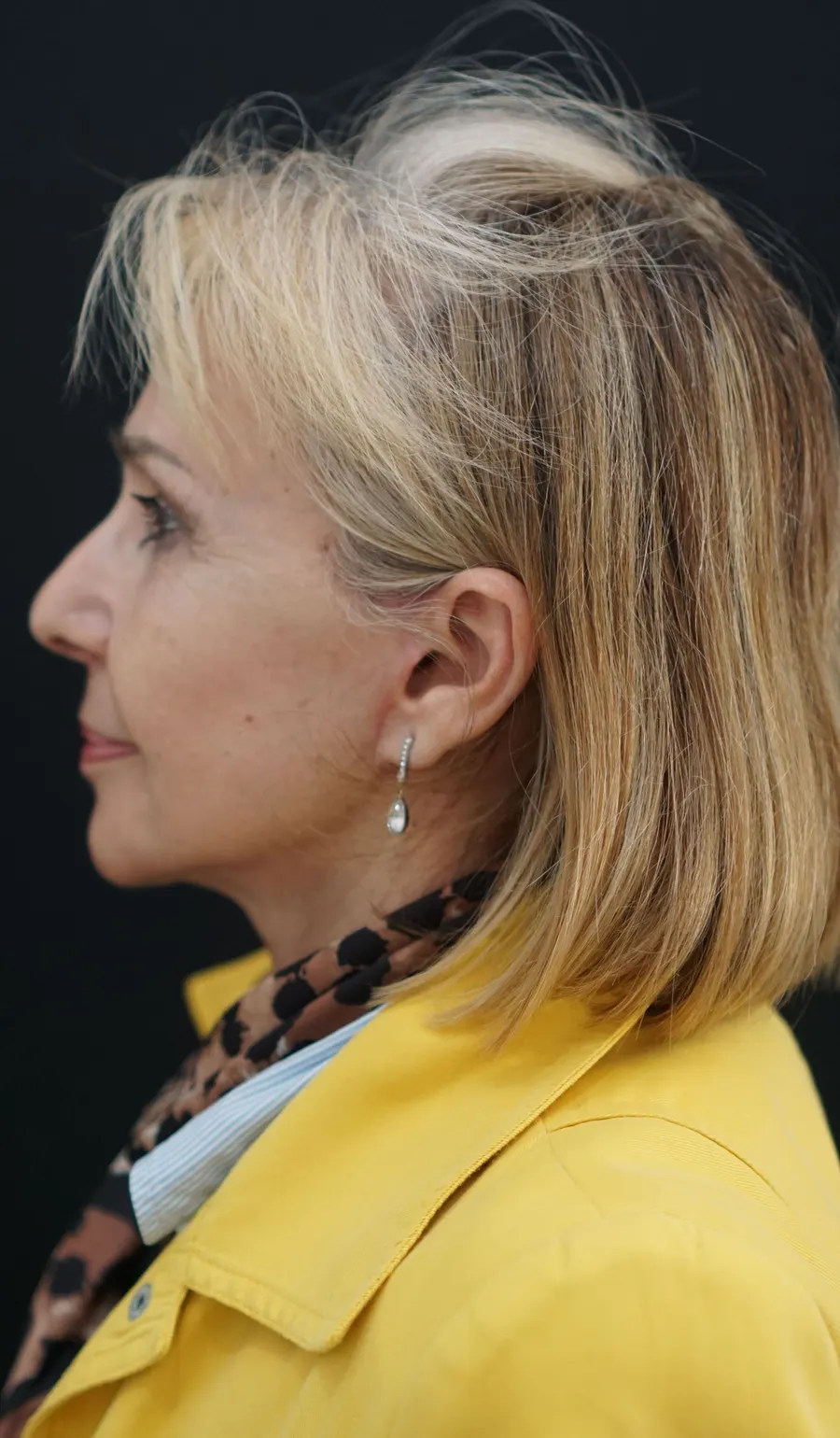 Lifting facial y cervical: resultado tras la intervención