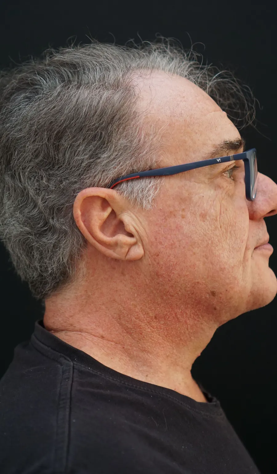 Lifting facial y cervical: resultado tras la intervención