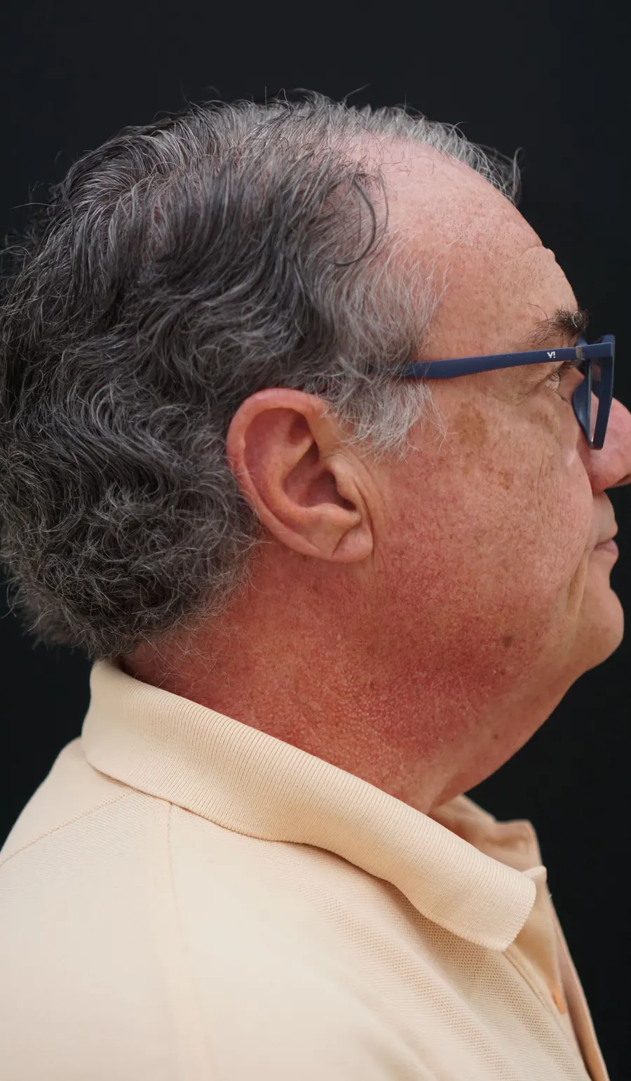 Lifting facial y cervical: antes de la intervención