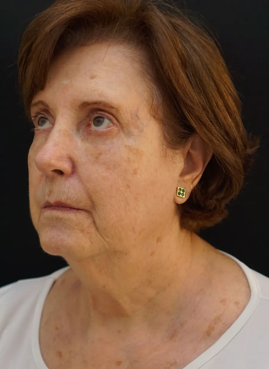 Lipofilling facial: resultado tras la intervención