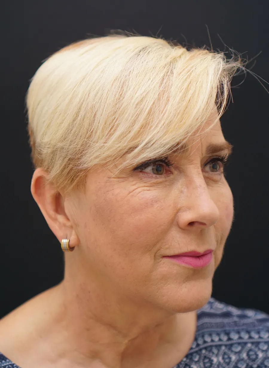 Lipofilling facial: resultado tras la intervención