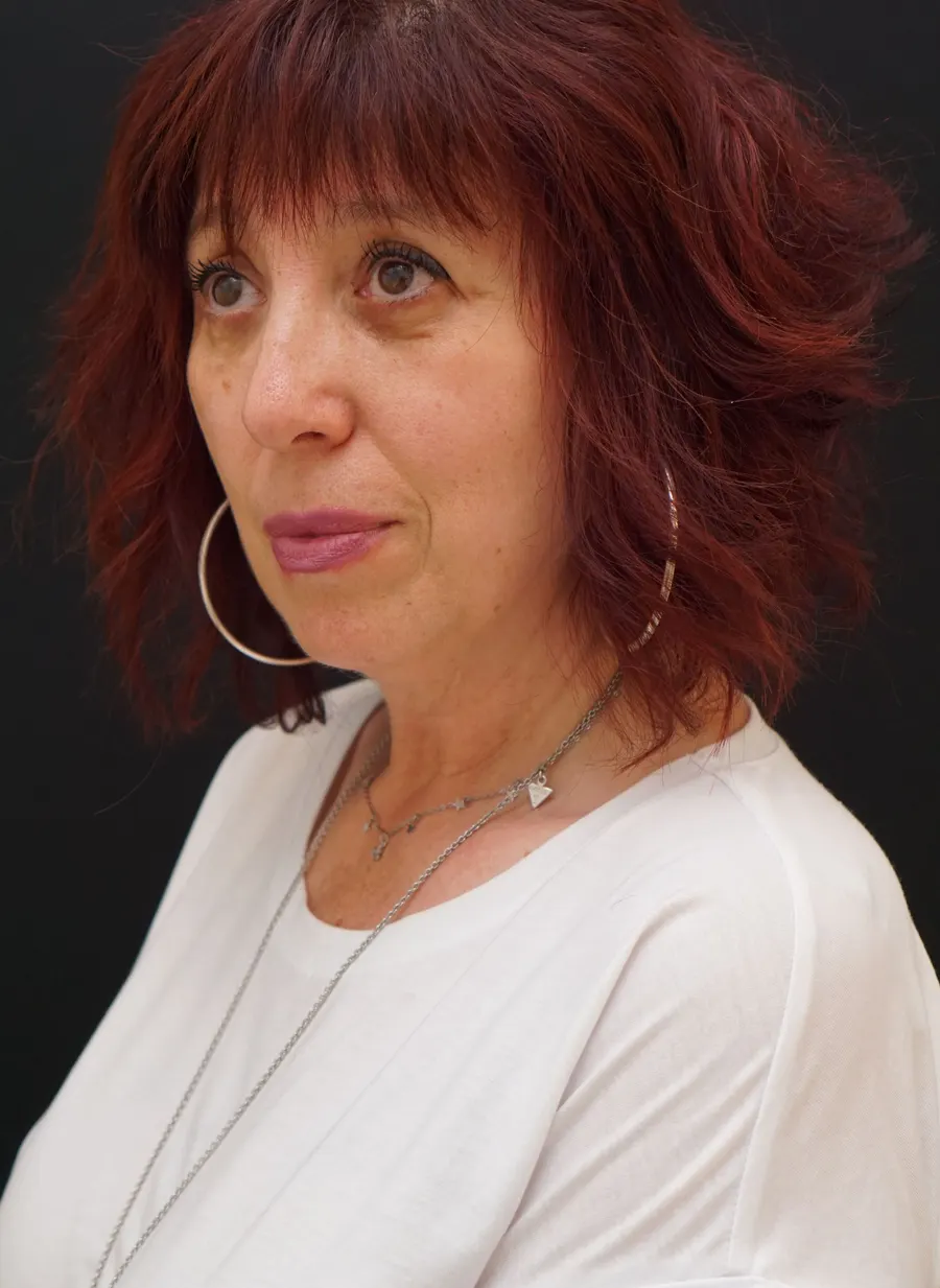 Lipofilling facial: resultado tras la intervención