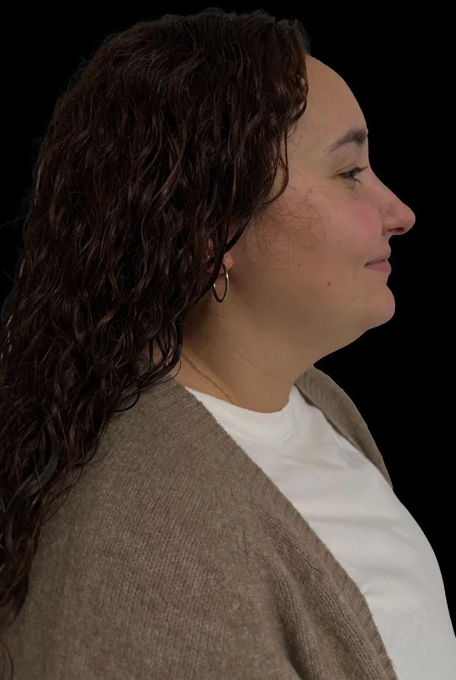 Liposucción facial: antes de la intervención